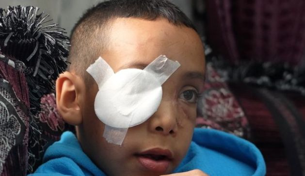 Palestinian boy shot in eye